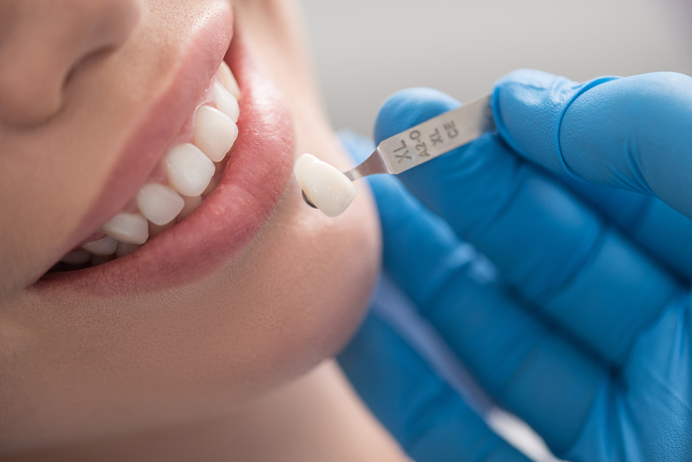 Ce este o coroana dentara si cand este necesara?