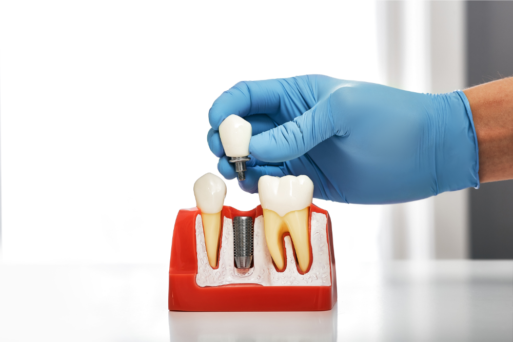 Implantul dentar: soluția modernă pentru un zâmbet perfect
