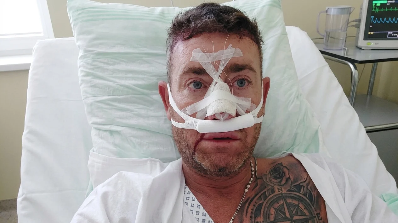 Christopher Maloney de la X Factor desfigurat de fillere. Cum arata dupa a douazecea operatie
